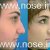 Nose Plastic Surgery by Dr. Mohsen Naraghi