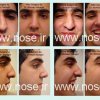 nose_surgery