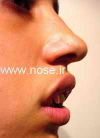 nose2