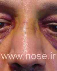 1 Nasal Fracture